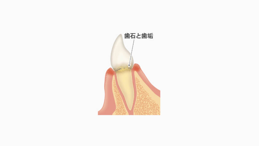 【歯周病の初期段階】歯肉炎