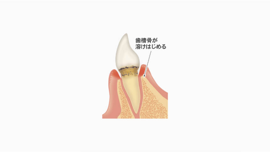 軽度歯周炎