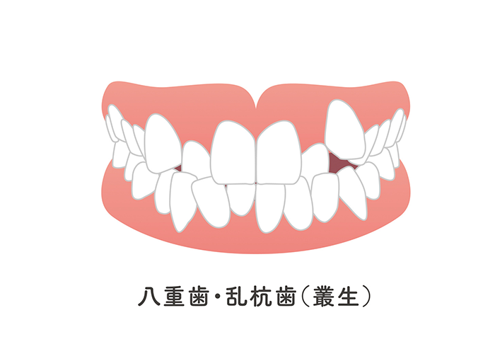 叢生(乱ぐい歯)
