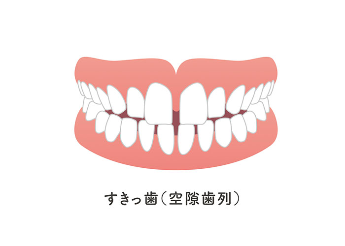空隙歯列(すきっ歯)