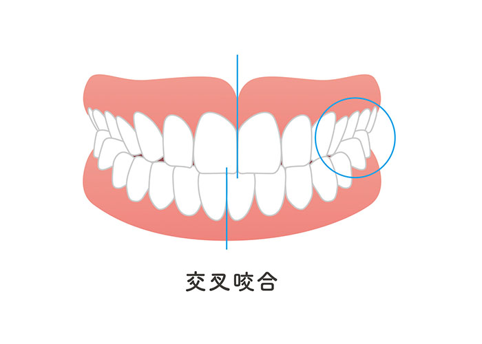 交叉咬合