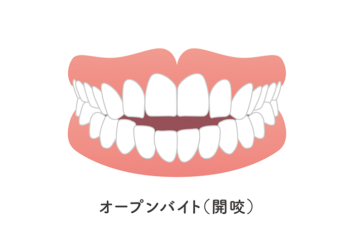 開咬