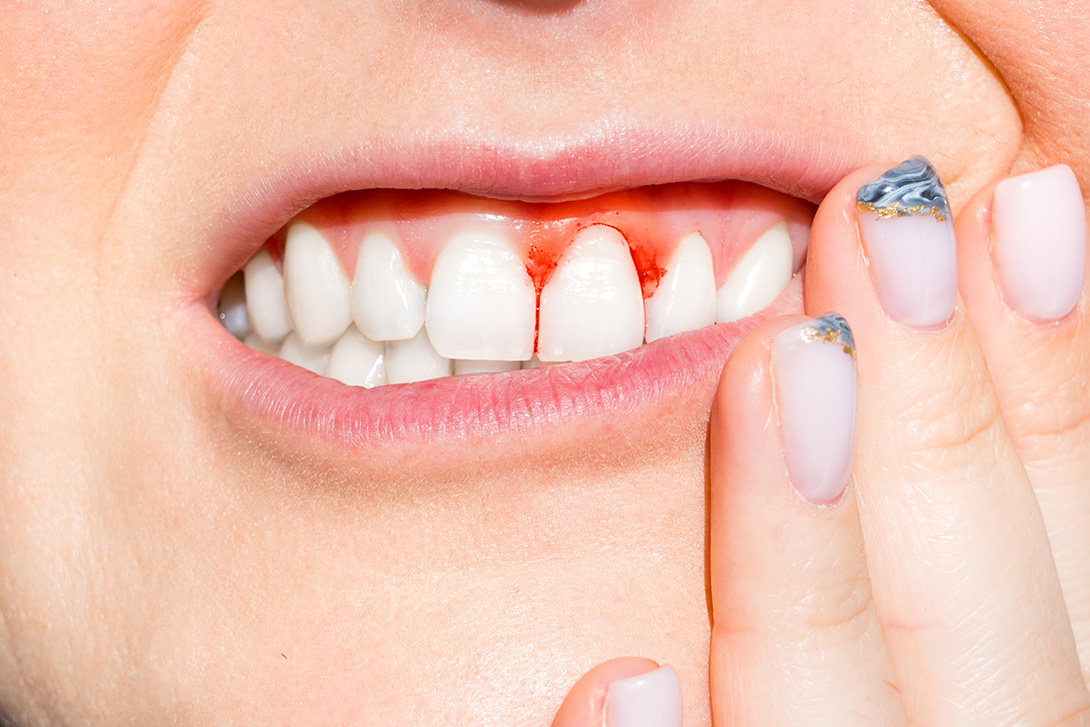 歯周病とは｜デンタルクリニック青木は代々木駅から徒歩2分の歯周病専門医のいる歯医者