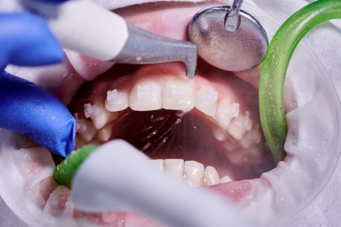 歯科医院での専門的なクリーニング｜デンタルクリニック青木