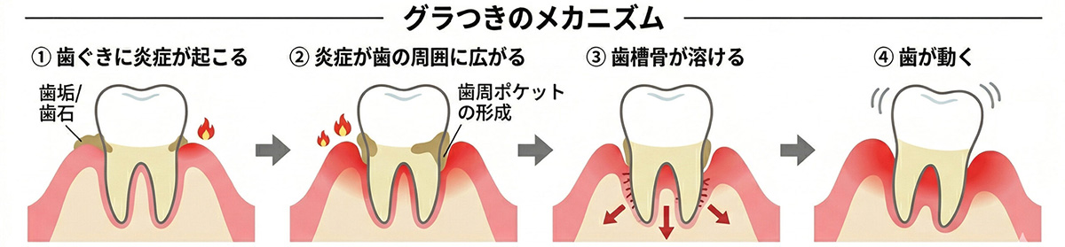 歯周病のぐらつきのメカニズム