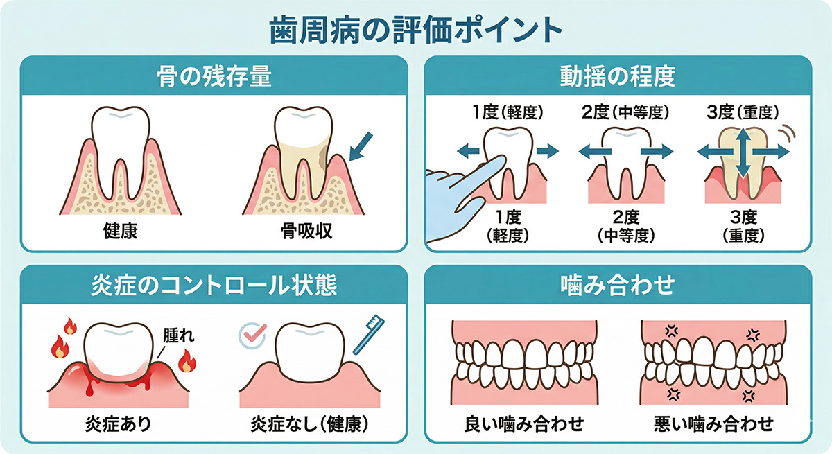 歯周病の歯を残せるかの評価ポイント